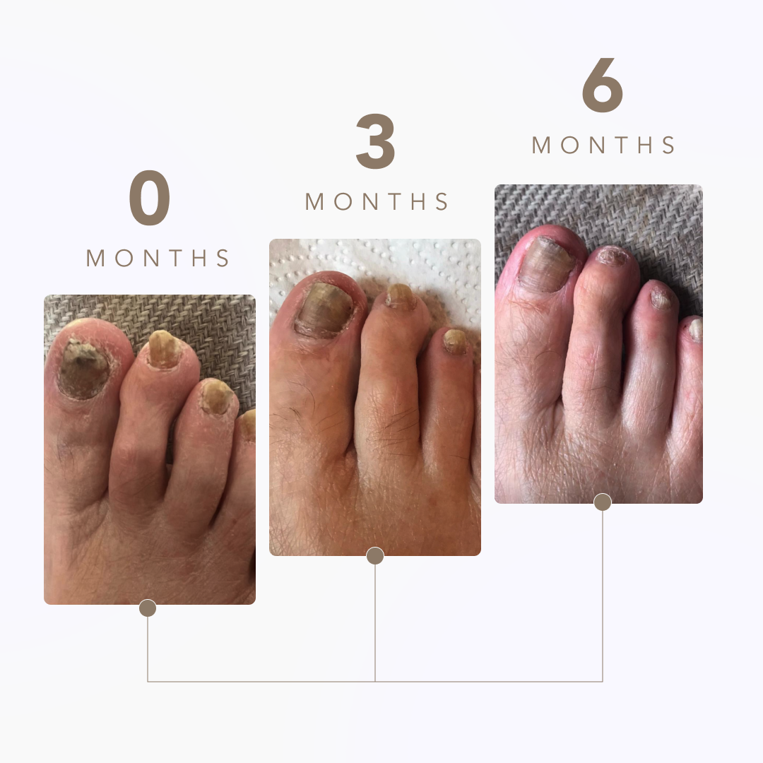 2528644 MDL PDP Fungal Nail Proof Graphic V3